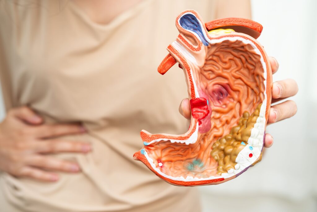 Gastroparesis Lawsuits